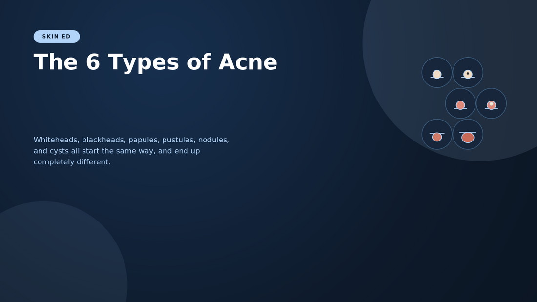 The 6 Types of Acne (And Why Your Routine Might Be Treating the Wrong One)