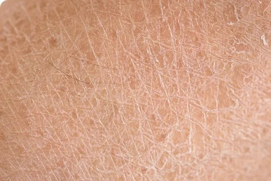 Dry Skin