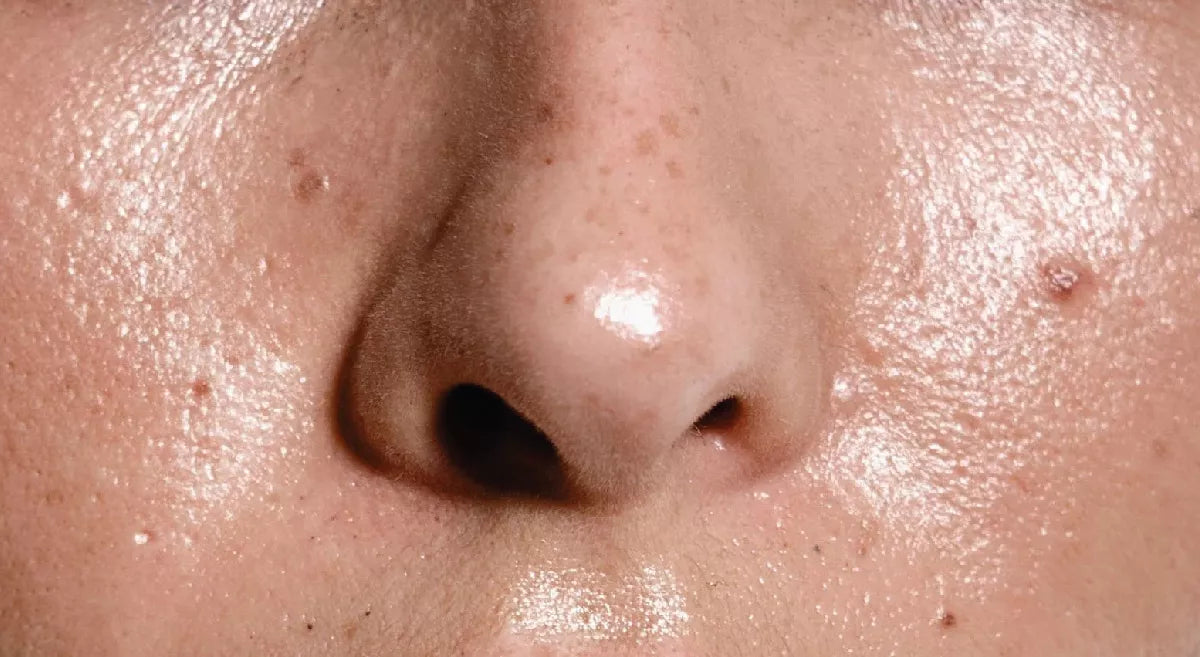 Oily Skin